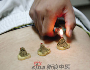 灸法的種類  你知道多少？